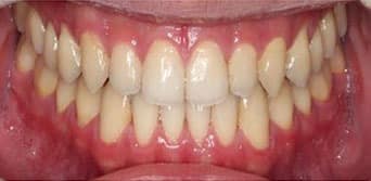 Tratamento Invisalign Depois 3